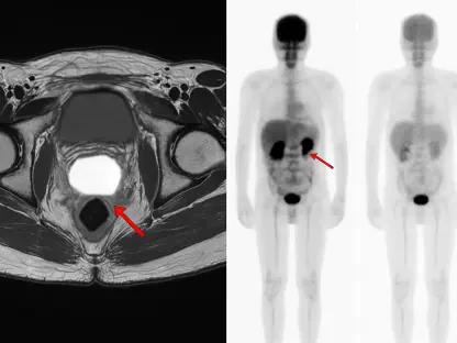 PSMA Scans Improve Recurrent Prostate Cancer Outcomes