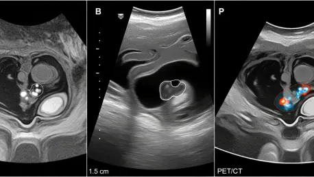 Ultrasound Matches MRI and PET/CT for Cervical Cancer Nodes